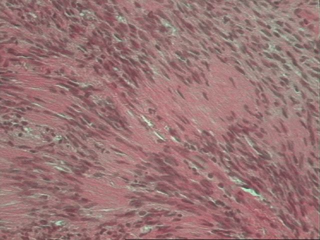 Foto microscpica a mayor aumento (40x) con la coloracin de H/E donde se pueden observar las celulas de ncleos fusiformes que forman este tumor y se disponen en estructuras como empalizadas.